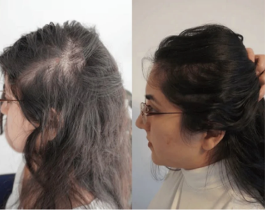 Avant / Après de Lola P.